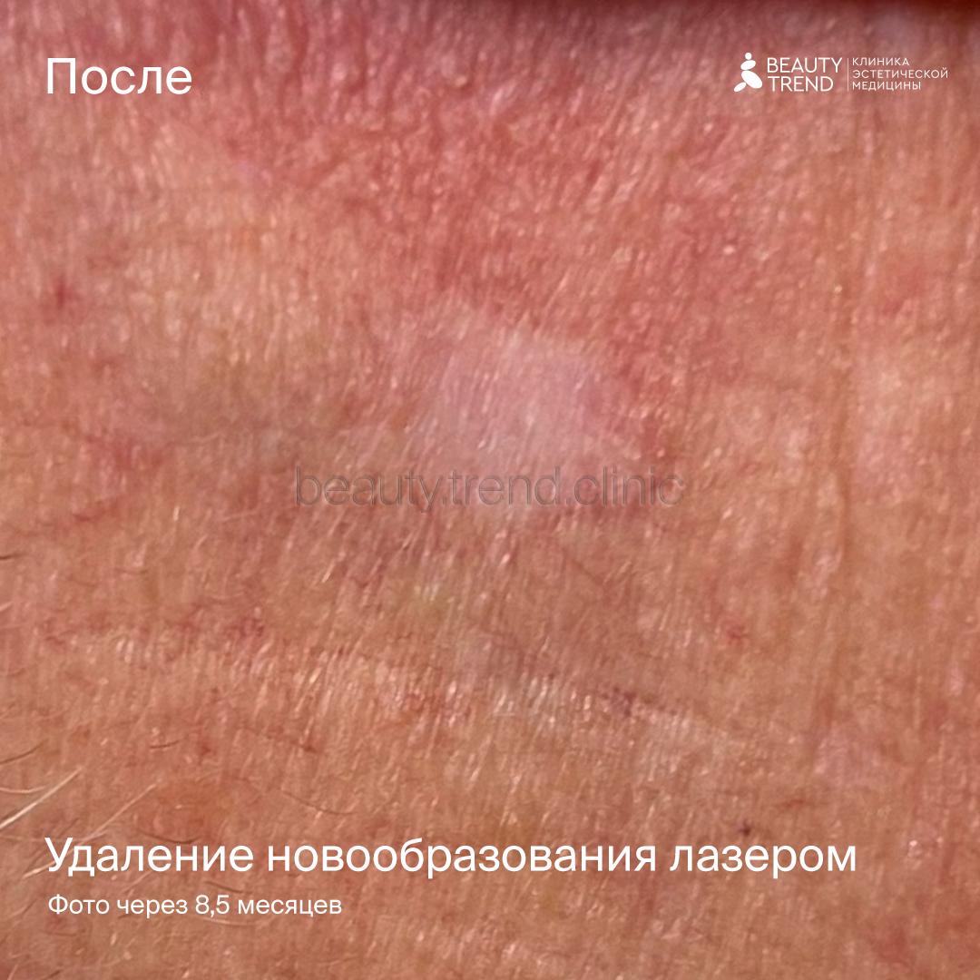 Удаление новообразований SmartXide - после 1